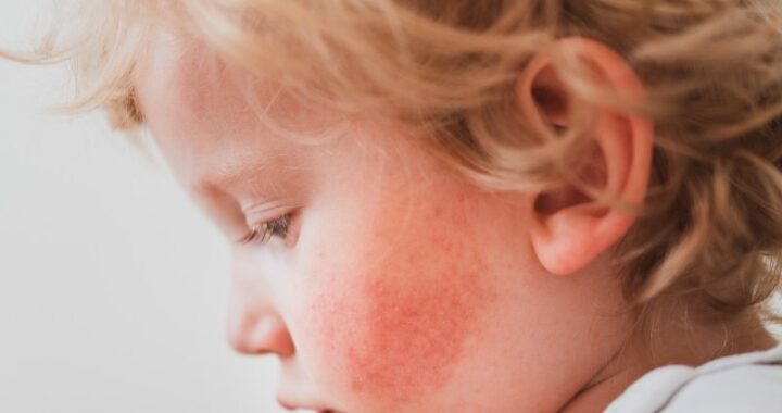 Jak skutecznie radzić sobie z atopowym zapaleniem skóry